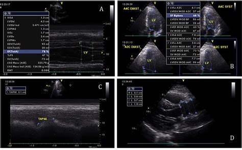 what is a normal echo lvef|echocardiogram numbers meaning.